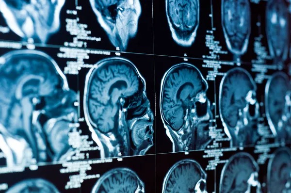 Put Away Your Crossword Puzzles! Scientists Edge Closer to Finding Solutions for Neurodegeneration